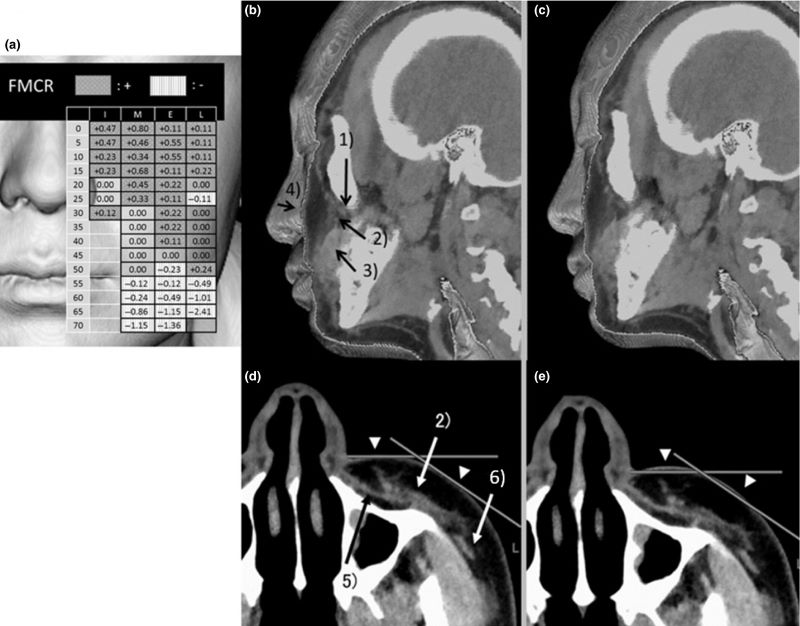 Analysis of morphological changes after facial massage by a novel approach using three-dimensional computed tomography